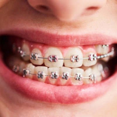 Invisible braces for a discreet orthodontic treatment